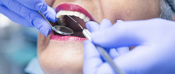 Best Emergency Dentist for Lost Fillings or Crowns in Linn, MO